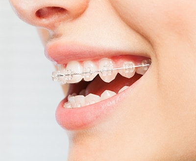 Ceramic Braces Advanced Orthodontics Bellevue, WA