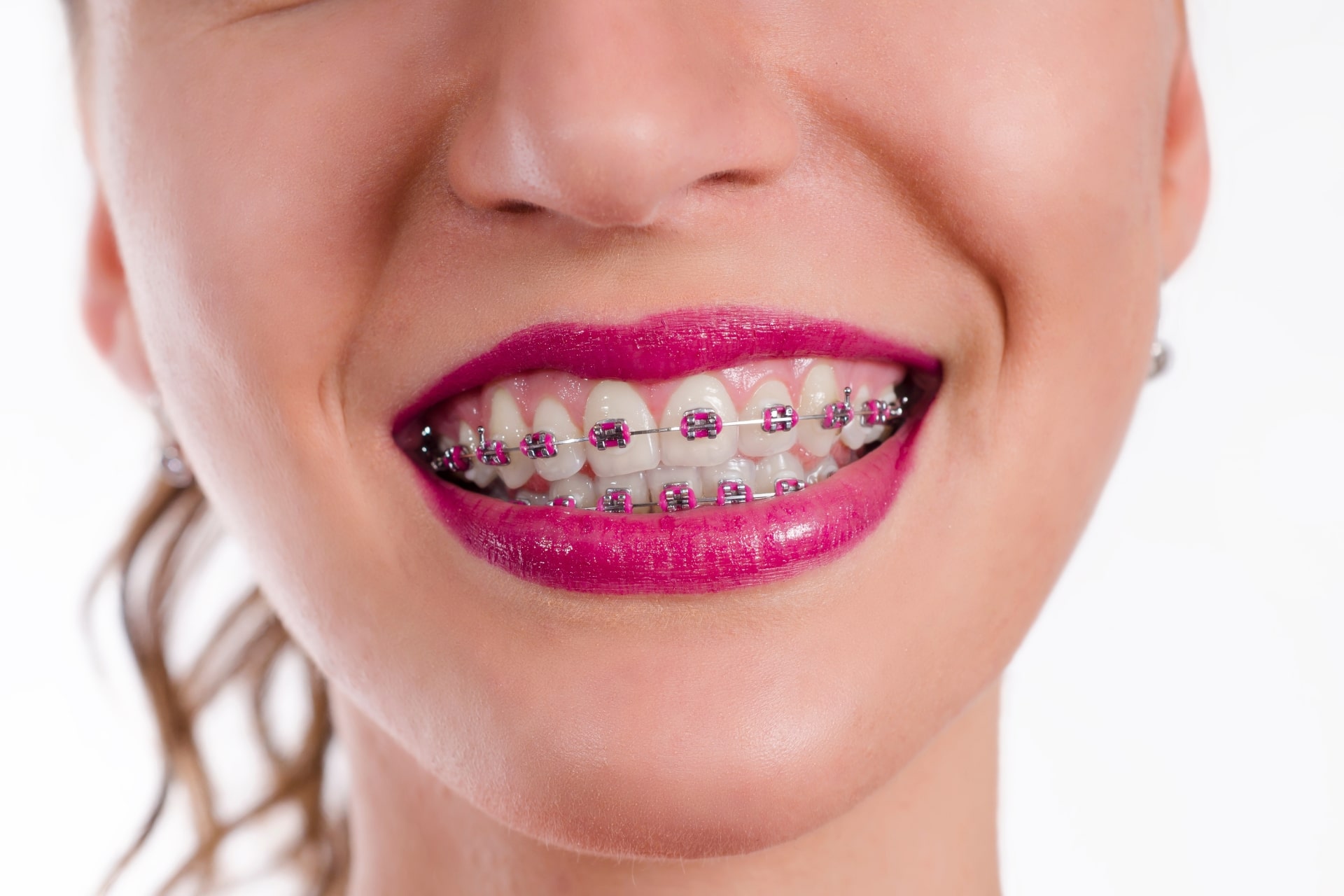Do I Need Tooth Extractions Before Braces in Bellevue, WA? Advanced Orthodontics
